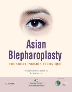 Asian Blepharoplasty - The Short Incision Technique